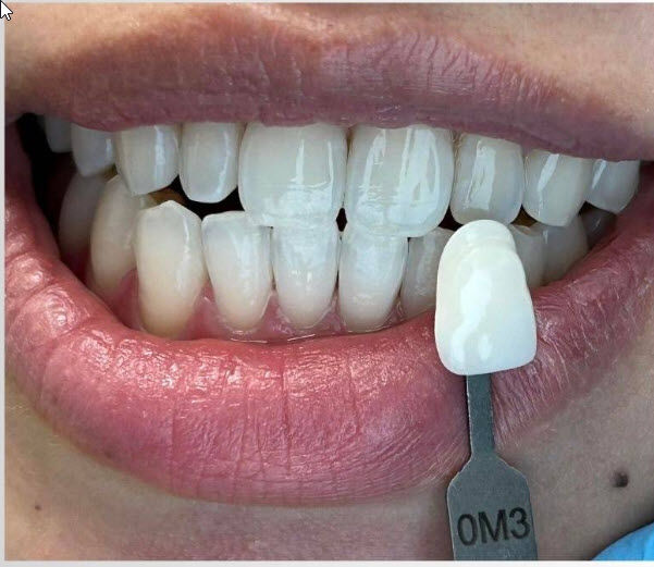 After Professional Teeth Whitening