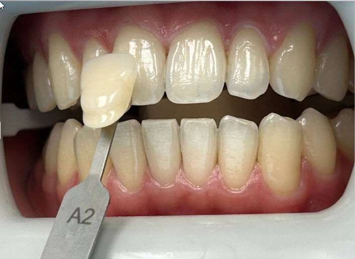 Before Professional Teeth Whitening