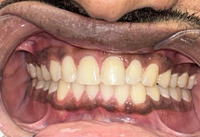 Invisalign
