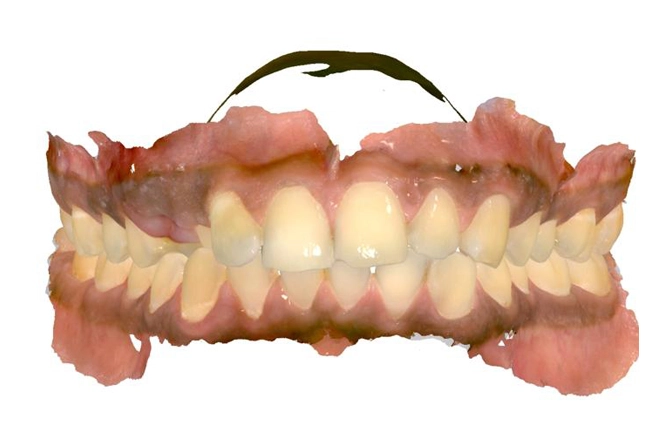 Invisalign