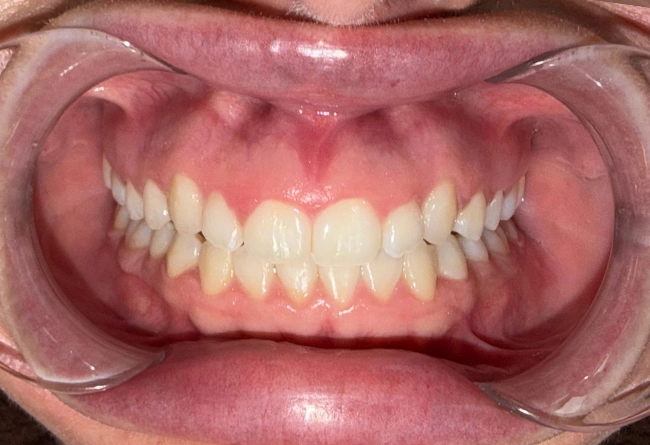 Invisalign