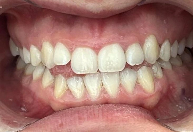 Invisalign