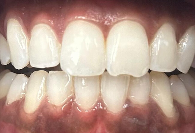 Whitening Case