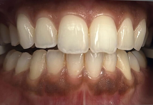 Whitening Case