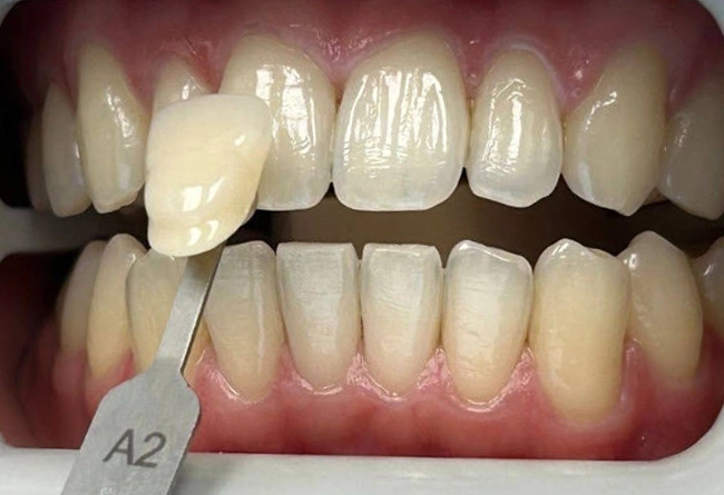 Whitening Case